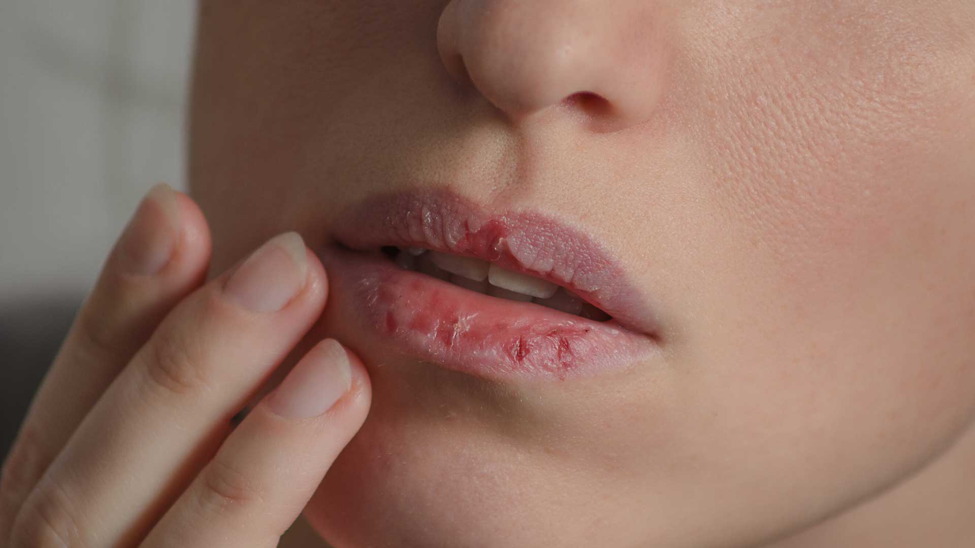 Jojoba Labios Partidos
